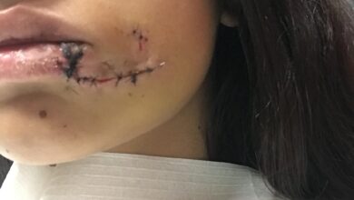 Lara Sanson Dog Bites Face 1